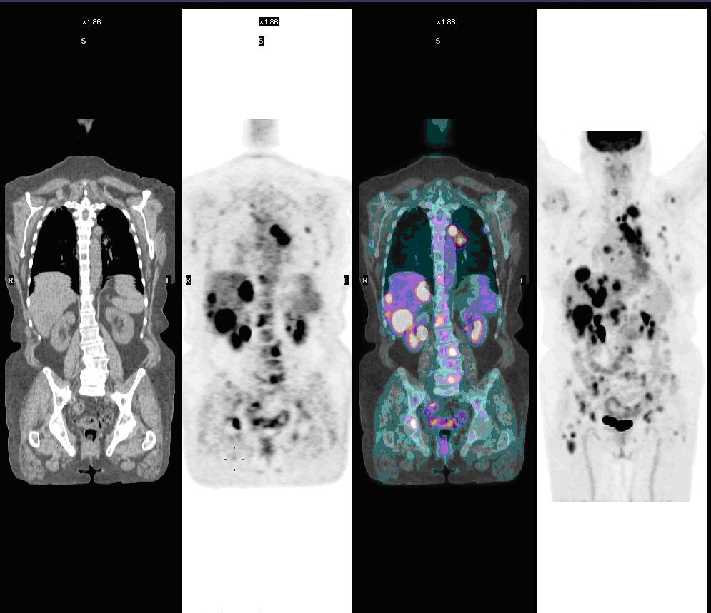 Whole-body oncology PET/CT showing CT, PET, fused PET/CT, and maximum-intensity projection views