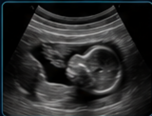 Obstetric ultrasound medical image
