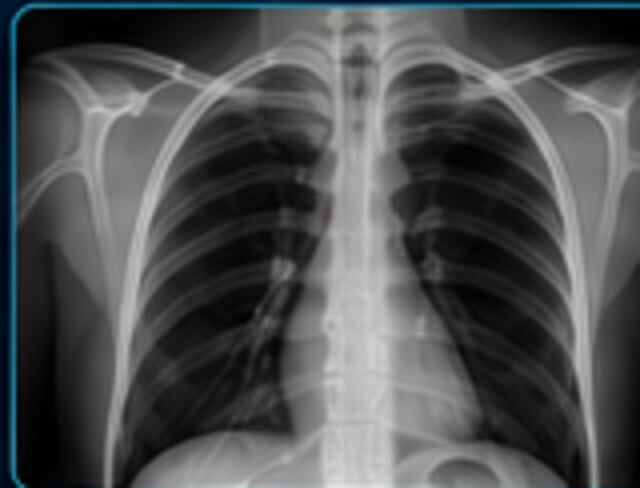 Chest X-ray medical image